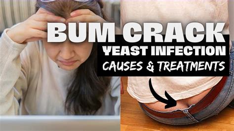 People can develop yeast infections anywhere, including the mouth, throat, vagina, penis, and anus. . Yeast infection on buttocks pictures